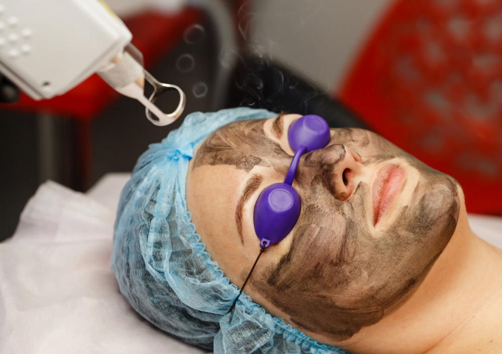 Carbon Laser